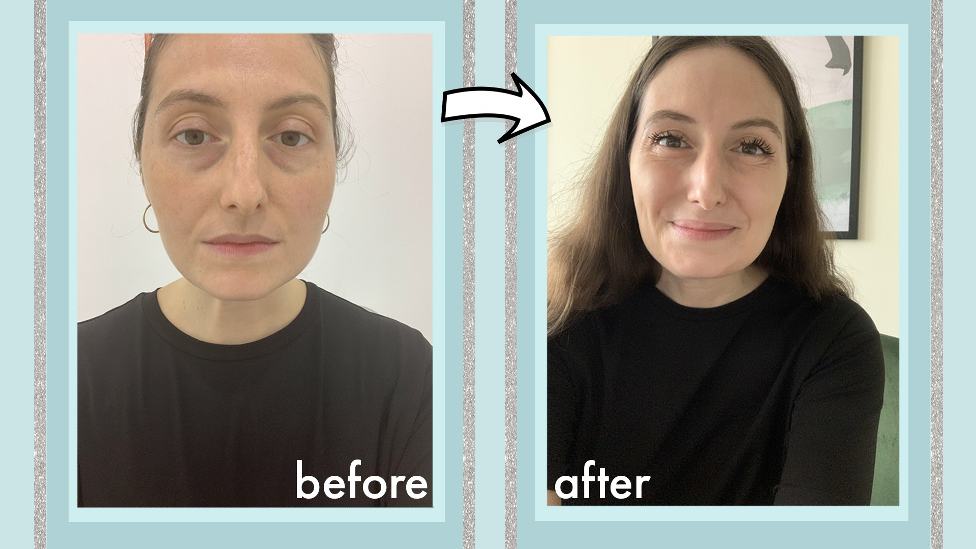 billet Bærbar tage medicin I tried a laser treatment for under-eye bags and the results were...great?!  | Cosmopolitan Middle East