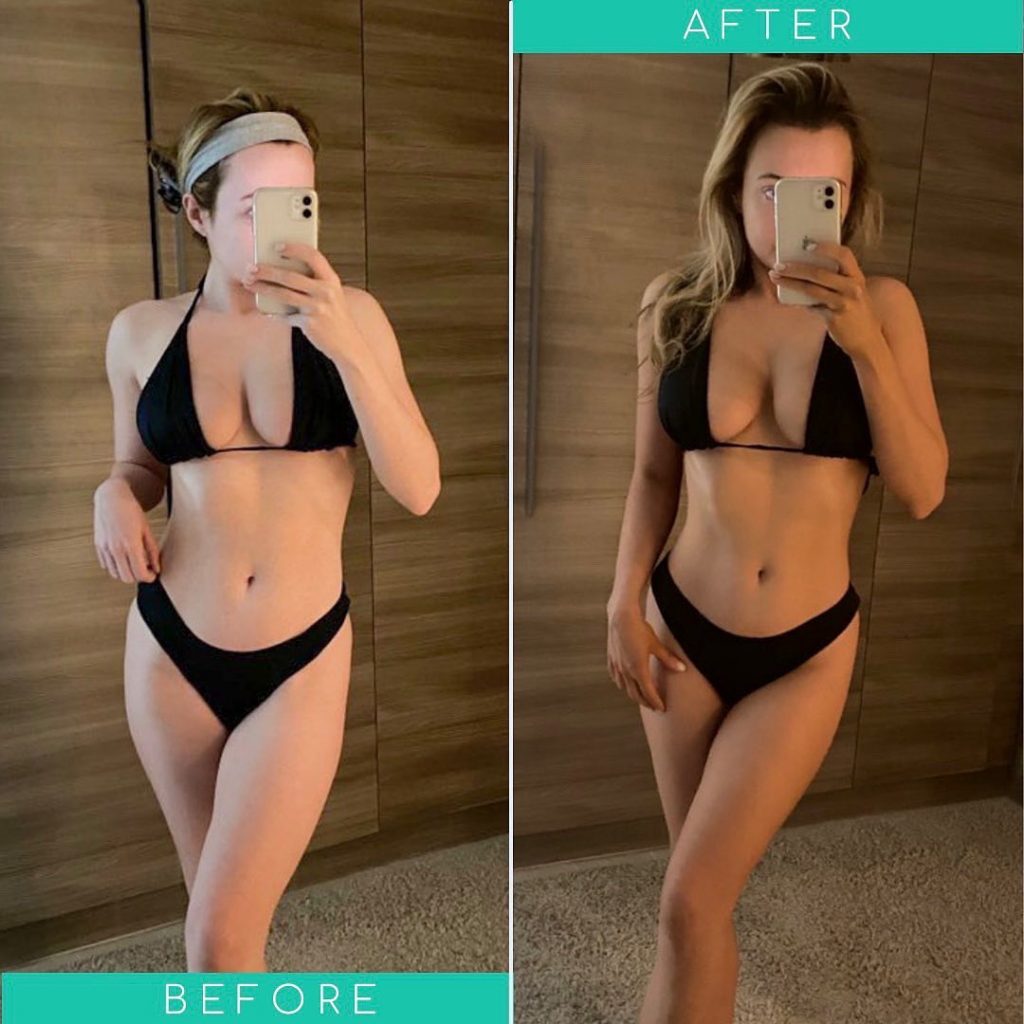 What is body contouring?